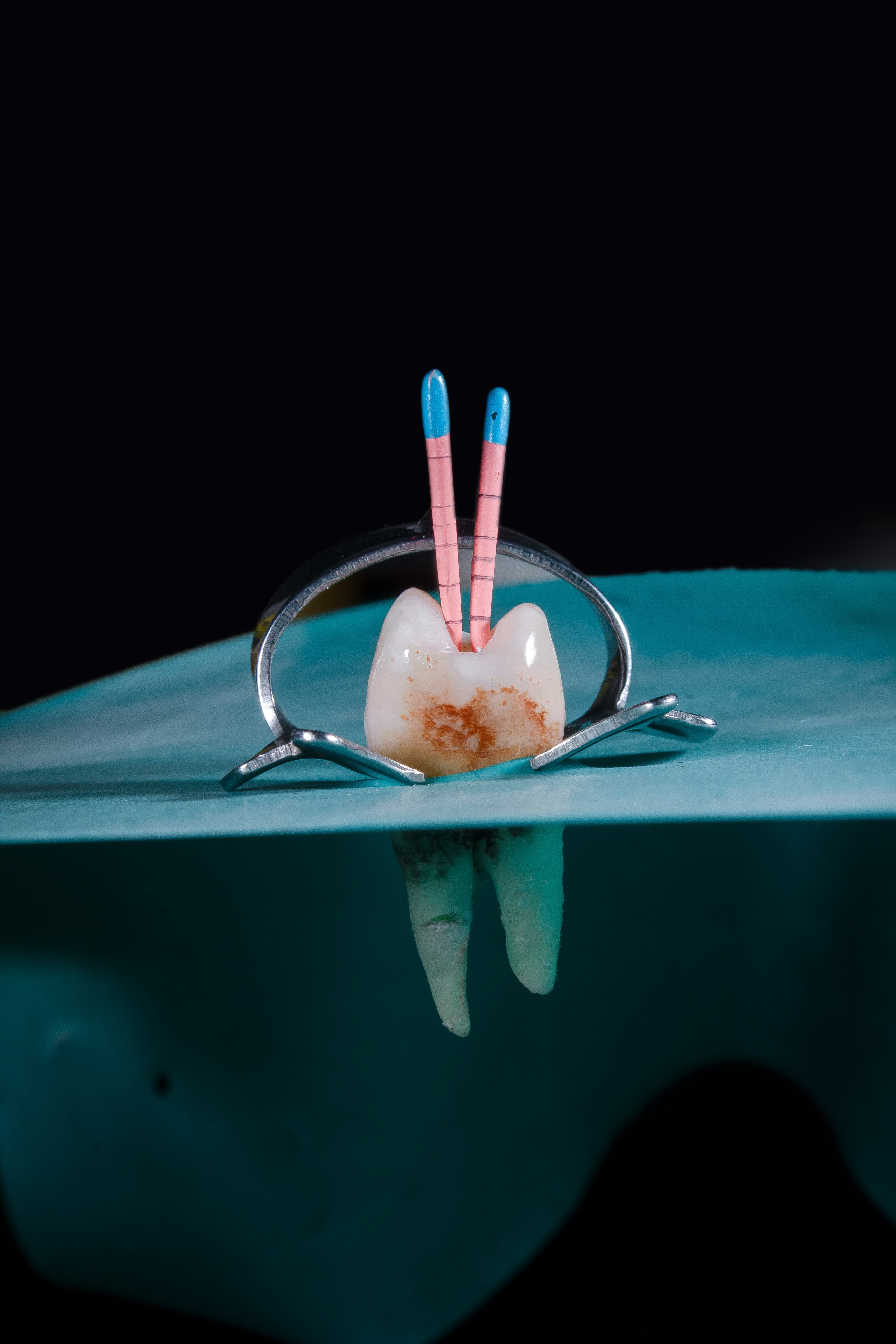 Эндодонтическое лечение: спасение зубов с пораженной пульпой