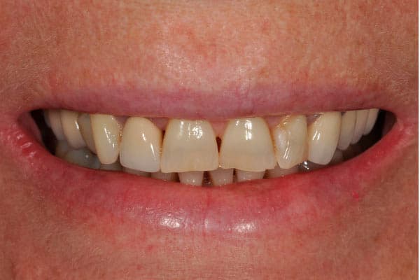 Отбеливание зубов