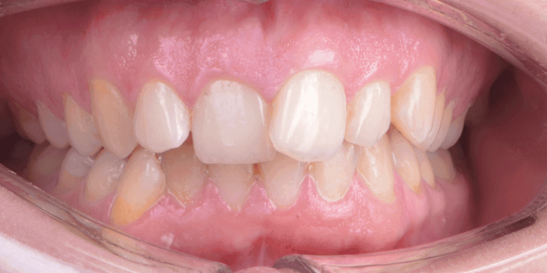 Установка брекет-системы